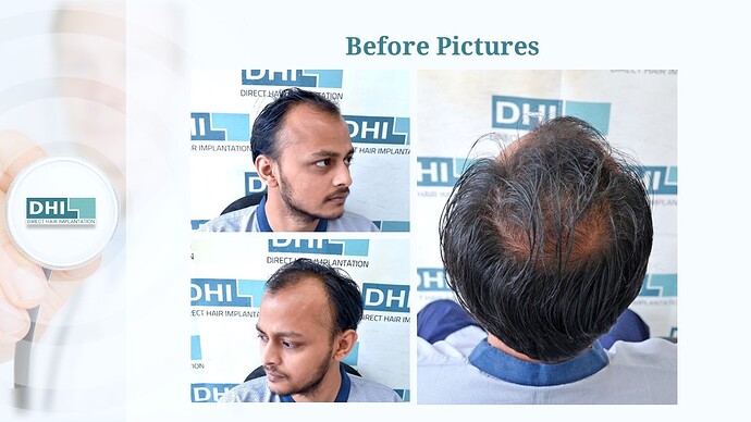 DHI India™ | NW 4 | 4,265 Grafts | 6-Months DHI™ Hair Transplant Results photo