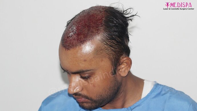 Dr. Suneet Soni - 5587 Grafts, Combine FUT + FUE + Beard Technique, NW : V-VI photo