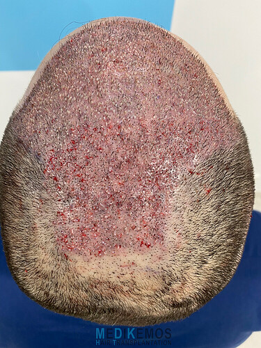 CASE DR. LUPANZULA - MEDIKEMOS CLINIC: 3112 UFS, FUE, FRONT AND MID SCALP photo