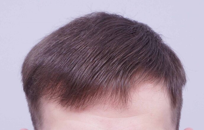 Dr B Farjo 1560g FUE (Frontal) photo