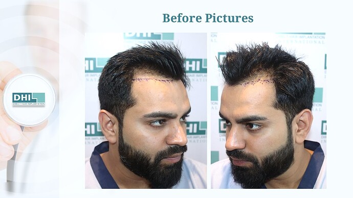 DHI India™ | NW 3 | 1,524 Grafts | Youthful Hairline Restored | DHI Hair Transplant photo