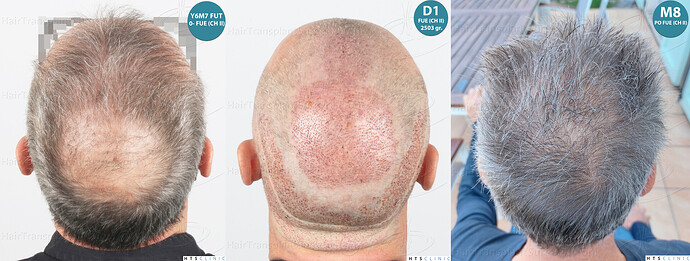 Dr Devroye + Dr Montesanti + Dr Jenard / 7015 grafts (4512 FUT + 2503 FUE) / 2 sessions photo