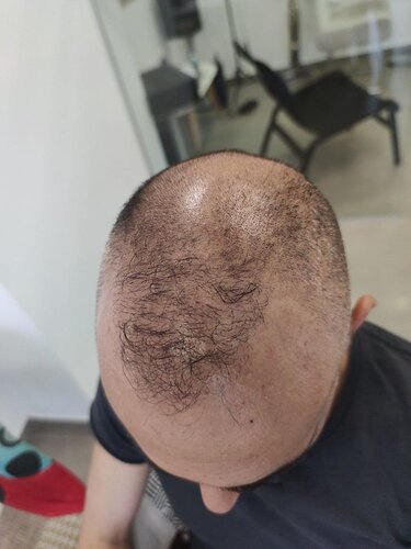 FUE repair Result after 6026 Grafts in two Sessions – HDC Hair Clinic – Dr Maras photo