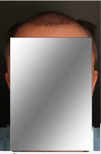 Hattingen Hair Clinic, 4 435: 4 093 FUT and 342 FUE. photo