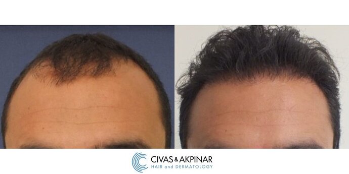 Civas&Akpınar Hair Transplant- FUE Hair Transplant Before & After Pictures (3100 Grafts) photo
