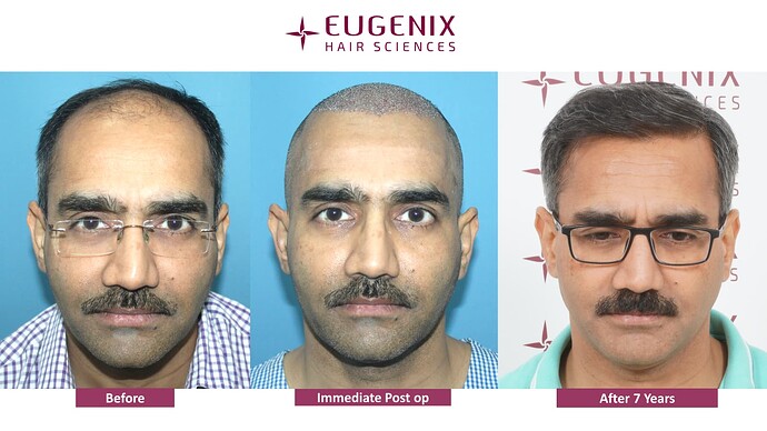 hair-transplant-before-after-7
