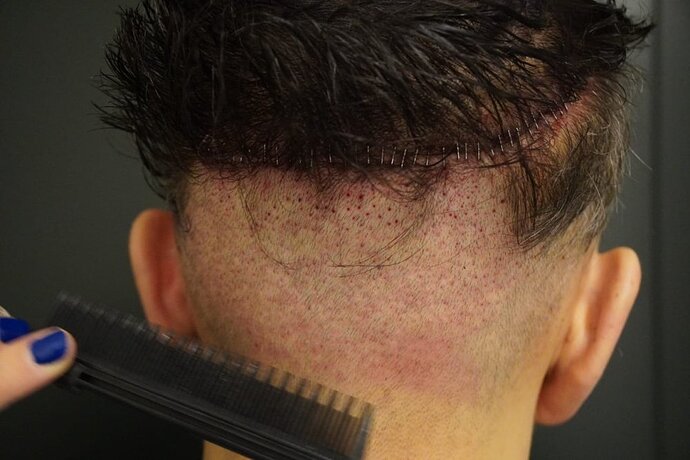 Hattingen Hair Clinic, 4 435: 4 093 FUT and 342 FUE. photo