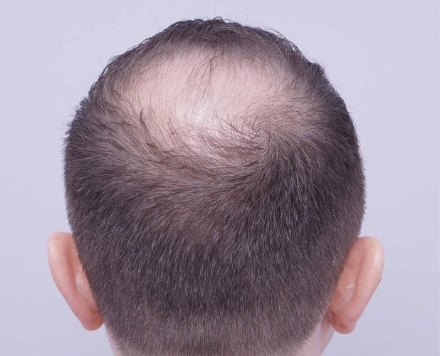 FUE Hair Transplant - 2,300 Grafts - Dr Bessam Farjo photo
