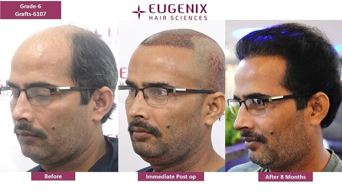 EUGENIX HAIR SCIENCES | NW 6 | 8 MONTHS RESULT | photo
