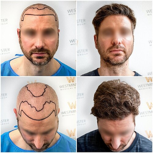 Westminster Medical Group London - 2539 Grafts - 12 Months Progress photo