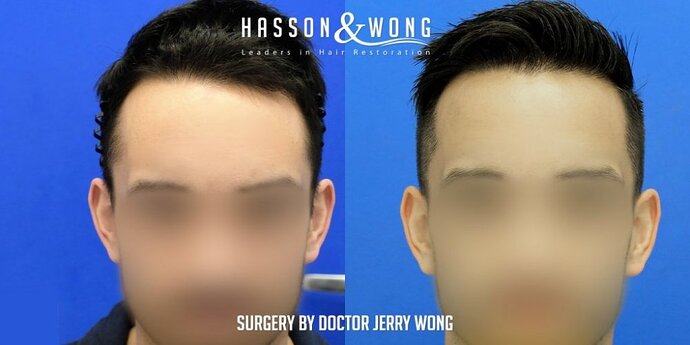 FUE Hair Transplant with Dr. Wong /1300 Grafts/ Hairline/temple points/ 1 Session/ 1 year post-op photo