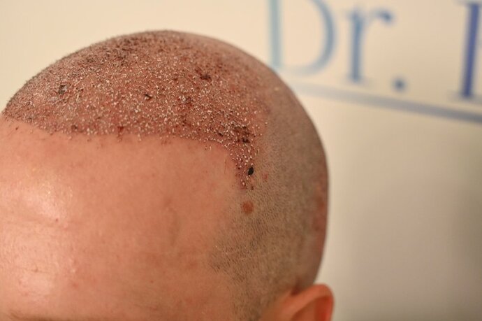 Ozlem Bicer MD-Hair Transplant-3980 Grafts FUE by micro-motor, 12. months result photo
