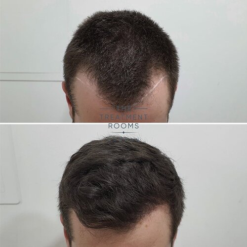 1297 Grafts- FUE Hair Transplant- The Treatment Rooms London photo