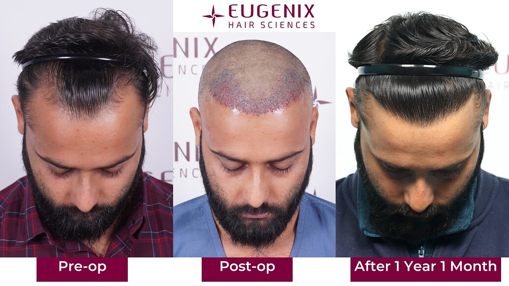 https://cdn.forumhairtransplant.com/optimized/3X/d/c/dc5832cf834001deb419590315980dc3a1b7dd64_2_1035x582.jpeg
