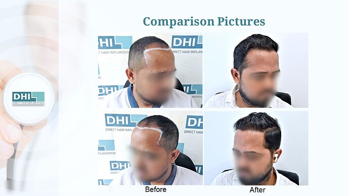 DHI India™ | NW 3 | 3,506 Grafts | 7 Months Hair Transplant photo