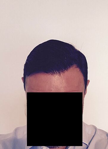 DR HAKAN DOGANAY/4055 GRAFTS/FUE+Implanter Pen photo