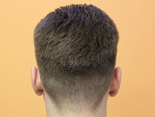 Dr.Bisanga, BHR Clinic, 1675 FUE, 0 - 13 Months photo
