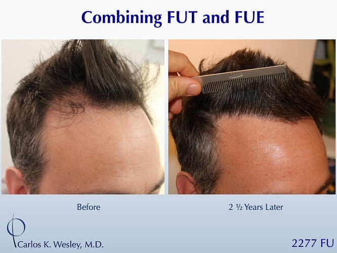 #BAM Most Natural Hairline (2277 FUE and FUT grafts): Carlos K. Wesley, M.D. (NYC & LA) photo