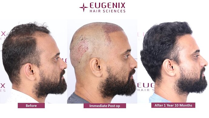 Eugenix Hair Sciences Clinic | Norwood Grade 3 | 22 Months Hair Transplant Results| photo