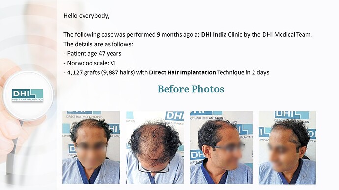 DHI India | NW Scale 6 | 4,127 Grafts | 9 Months DHI Hair Transplant Result photo