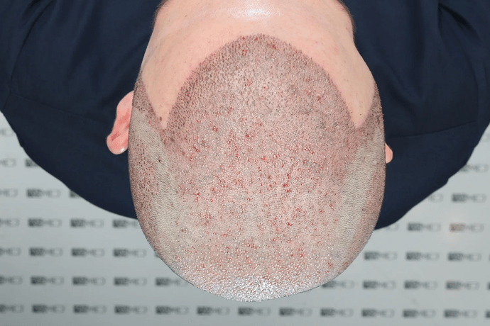 ASMED, Istanbul: 5,071 Manual FUE Grafts 0/12 Months photo