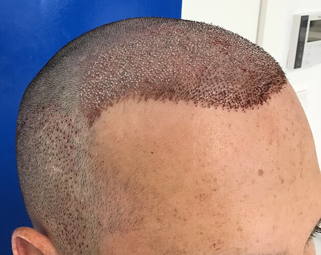Dr.Bisanga + Dr.Kostis, 2980 FUE 0 - 5 MONTHS..SUPER FAST AND DENSE GROWTH!! photo