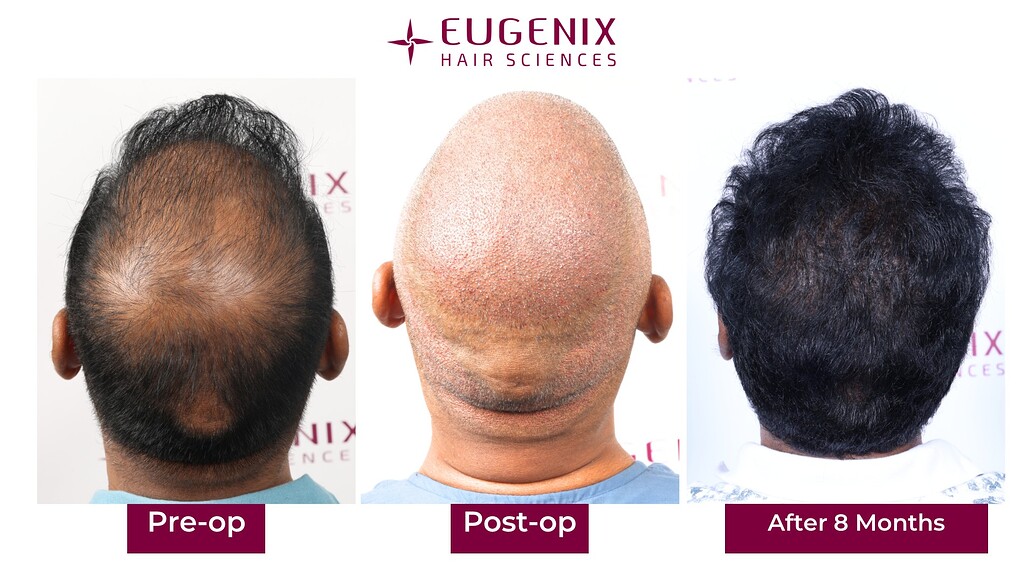 https://cdn.forumhairtransplant.com/optimized/3X/d/c/dcfbd67c4d9e7a480a8d19b305909b49deb4bb65_2_1035x582.jpeg