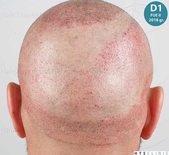 Dr. Jean Devroye, HTS Clinic / 5280 FUE (2008 + 2018 + 1254) / 3 sessions photo