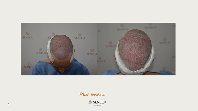 Seneca Medical Group - 3200 grafts with Direct Fue photo