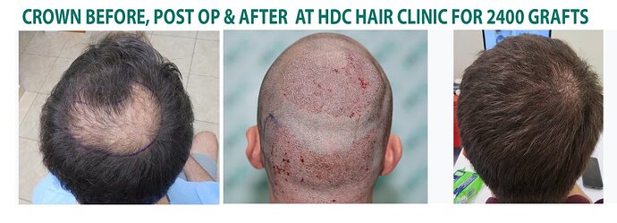 2400 Grafts Crown Result – 9 Months After – HDC Hair Clinic – Dr Maras photo
