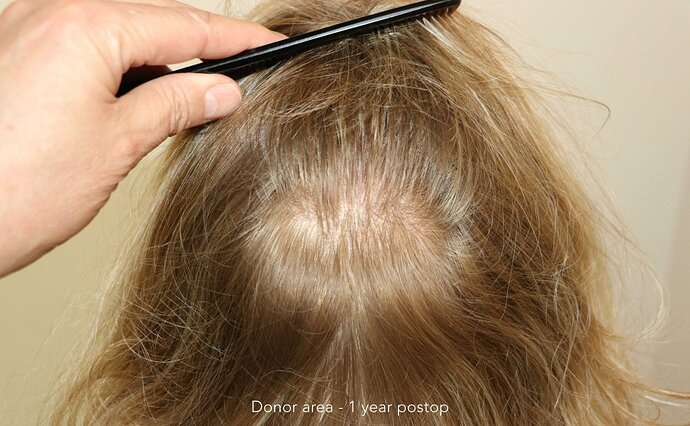Case performed by Dr. Feriduni – 2027 FU in 1 procedure photo