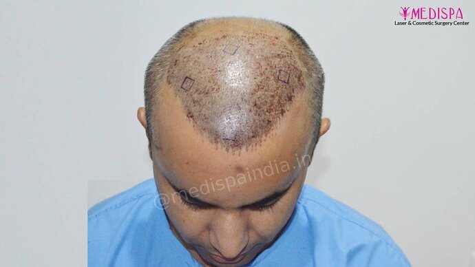 11600 Grafts in 3 FUT Sittings by Dr Suneet Soni photo