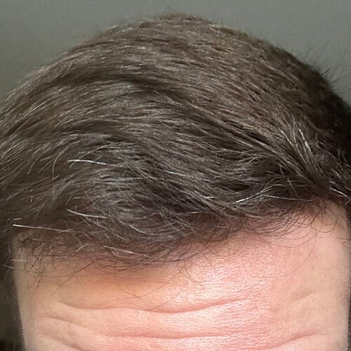 Dr. Bisanga & Dr. Kostis - 2955 FUE - 9 Months - Front & Crown photo