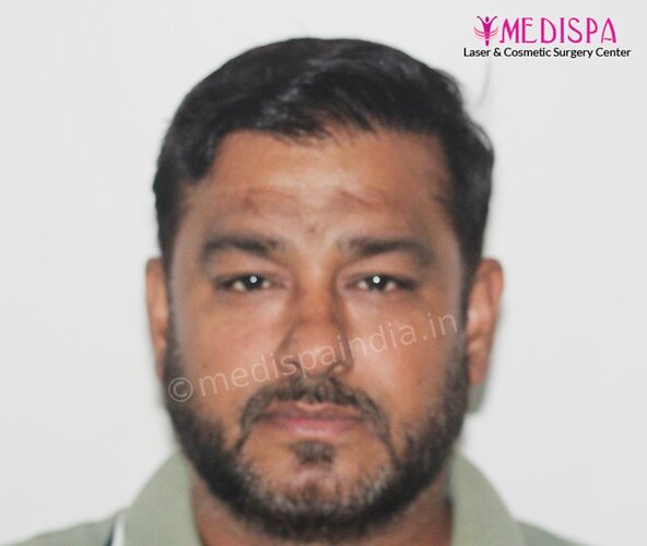 Dr. Suneet Soni - 5000 Grafts, Combine FUT + FUE + BHT (Beard) Technique, NW-V, 2.5 Year Result photo