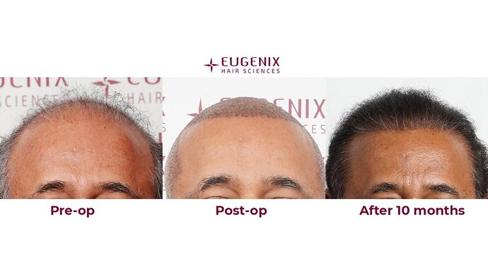 Eugenix Hair Sciences| NW 7 | 6309 Grafts | 10 Months Post-op| Dr. Pradeep Sethi photo