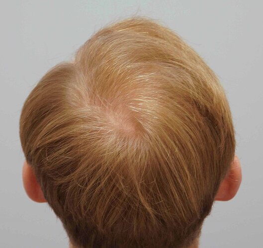 Dr B Farjo 1820 FUE (Fontal) Very early growth. photo
