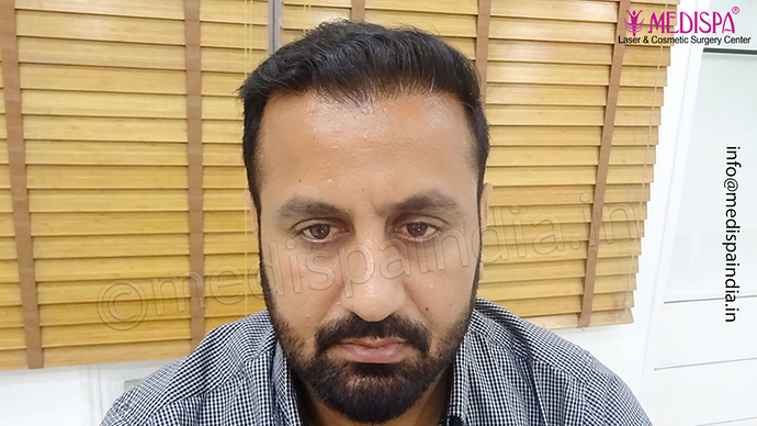 Dr. Suneet Soni - 5334 Grafts, Combine FUT + FUE + BHT (Beard) Technique, NW- V photo