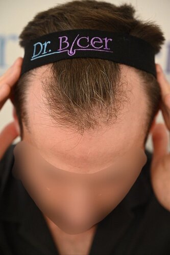 Ozlem Bicer MD-2340 Grafts FUE by micro-motor, 12. month result  photo