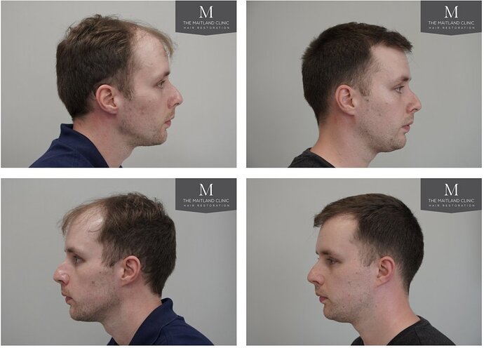 The Maitland Clinic - 2027 grafts by FUE photo