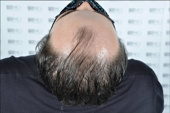 ASMED CLINIC - DR.KORAY - 5060 GRAFTS FUE photo