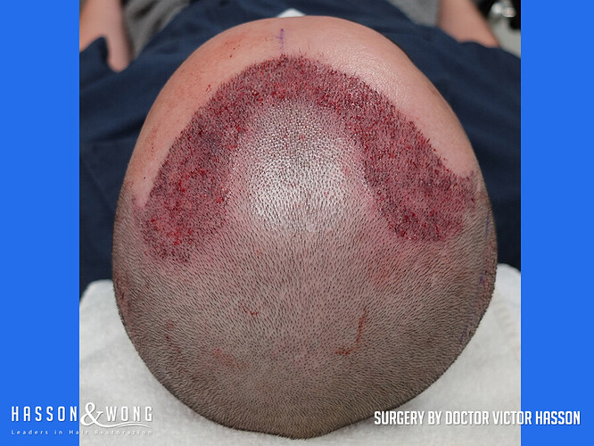 Dr. Hasson / 3055 grafts / Dense pack / FUE / frontal zone / 1 year post-op photo