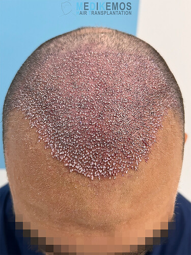 CASE DR. LUPANZULA - MEDIKEMOS CLINIC: 3017 UFS, FUE, FRONT, TEMPLES AND LOW MIDSCALP photo