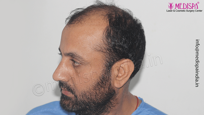 Dr. Suneet Soni - 5334 Grafts, Combine FUT + FUE + BHT (Beard) Technique, NW- V photo
