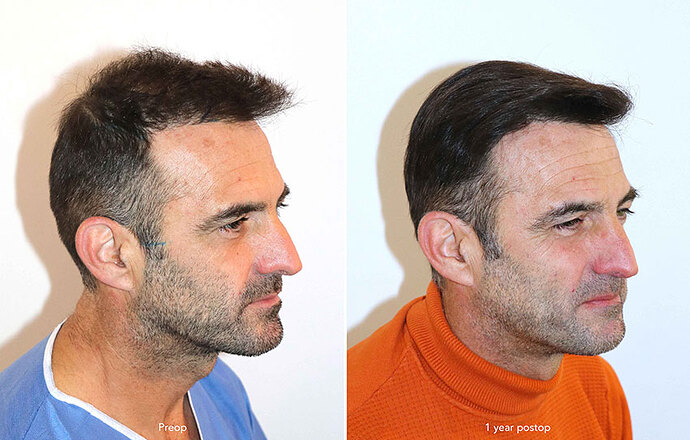 Case performed by Dr. Feriduni – 3144 FU in 1 procedure photo