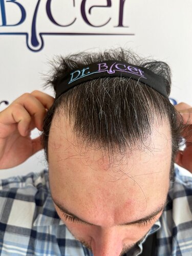 Ozlem Bicer MD-Hair Transplant-3890 Grafts FUE by micro-motor, 12. months result photo