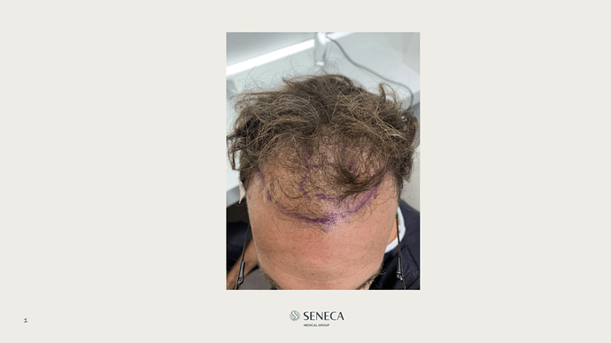 Seneca Medical Group - 1700 grafts with Direct Fue photo