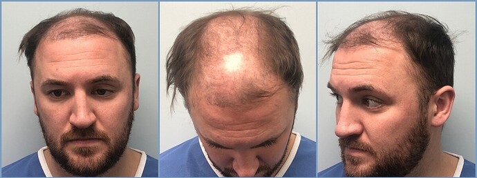 Dr. Nikos hair transplant result, grown out - hairline back over the mid-scalp 2850 grafts photo