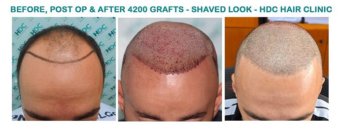 Two FUE Surgeries Totaling 6560 Grafts – HDC Hair Clinic photo