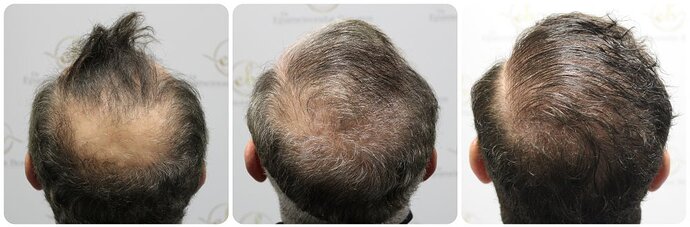 Dr Bonaros, Glasgow, UK / 3986 FUE grafts / 0-12 Months photo