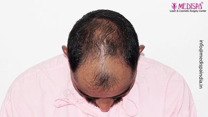 Dr. Suneet Soni - 5360 Grafts | 12-Month Result | Combination FUT + FUE + Beard photo